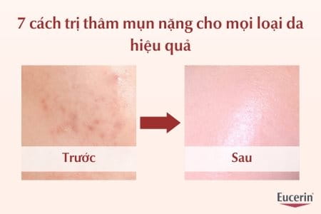 Cách trị thâm mụn nặng cho da an toàn, hiệu quả