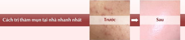 Cách trị thâm mụn hiệu quả nhanh nhất