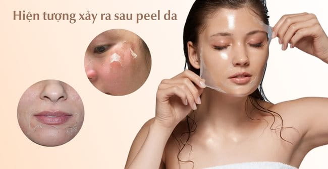 Các hiện tượng xảy ra sau khi peel da