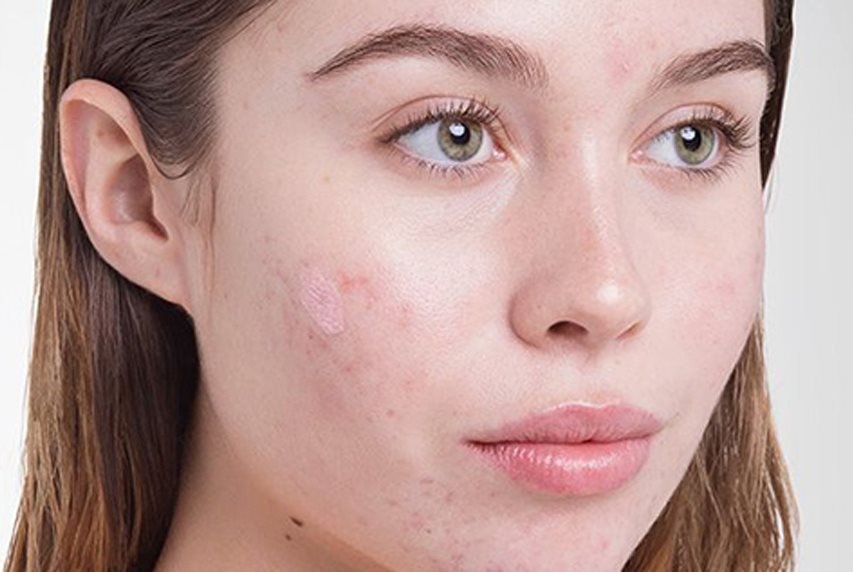 chăm sóc da mụn và thâm