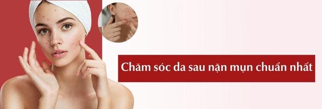 Chăm sóc da sau nặn mụn đúng cách hiệu quả, giúp da giảm thâm sẹo