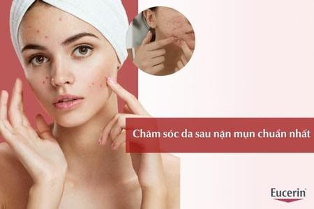Tại sao không nên sử dụng sản phẩm trang điểm hoặc chăm sóc da quá dày sau khi nặn mụn?
