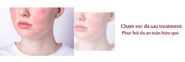 Chăm sóc da sau treatment đúng chuẩn hiệu quả