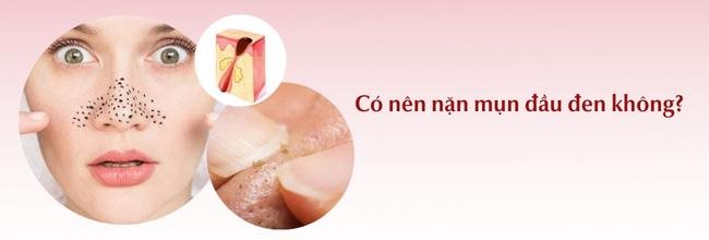 Có nên nặn mụn đầu đen không? Cách thực hiện an toàn