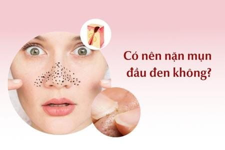 Nên hay không nên nặn mụn đầu đen và cách thực hiện an toàn