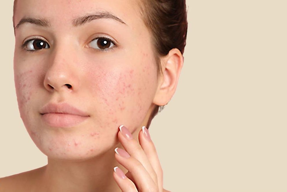 có nên nặn mụn không