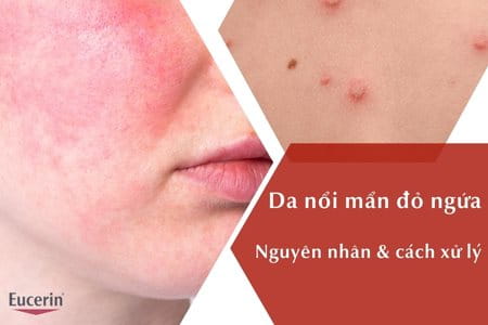 Mẩn Đỏ Ngứa Ở Mặt: Nguyên Nhân, Cách Điều Trị Và Phòng Ngừa Hiệu Quả