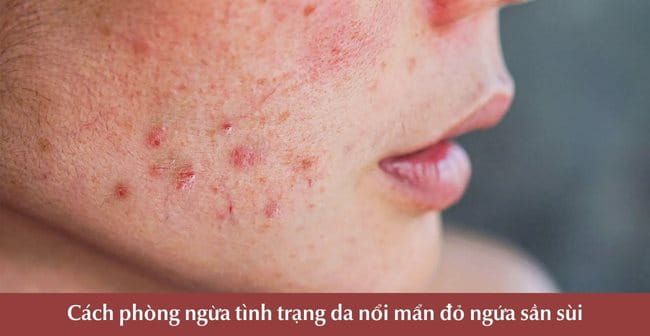 Cách phòng ngừa tình trạng da nổi mẩn đỏ ngứa