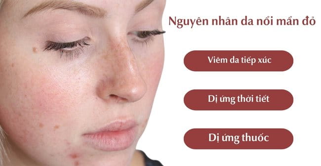 Nguyên nhân khiến da nổi mẩn đỏ ngứa