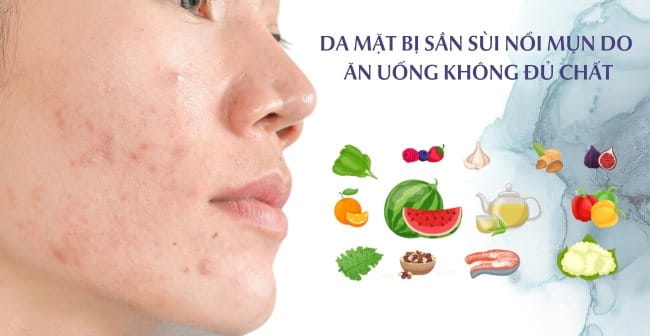 Da mặt bị sần sùi nổi mụn do chế độ ăn uống không đủ chất