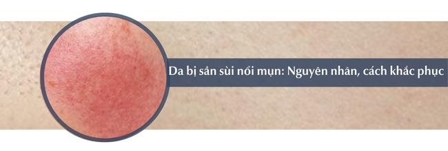 Da bị sần sùi nổi mụn