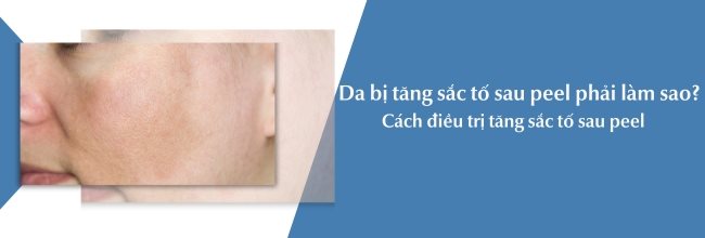 Da bị tăng sắc tố sau peel phải làm sao? Cách điều trị