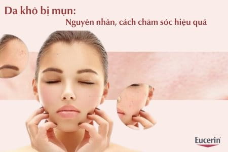 Da khô bị mụn nguyên nhân do đâu? Cách chăm sóc da khô mụn hiệu quả