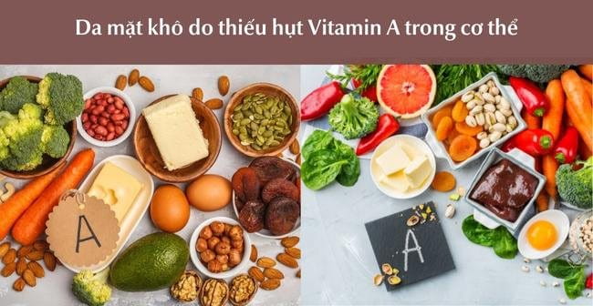 Da khô do thiếu vitamin A