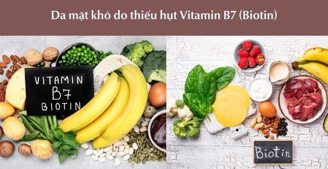 Da mặt khô do thiếu vitamin B7 (Biotin)