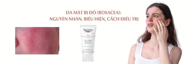 Da mặt bị đỏ