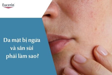 Da Mặt Bị Ngứa Và Sần Sùi Do Đâu? Điều Trị Thế Nào? | Eucerin