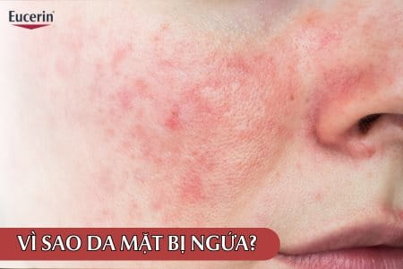 Vì Sao Da Mặt Bị Ngứa Thường Xuyên? Làm Sao Để Da Hết Ngứa