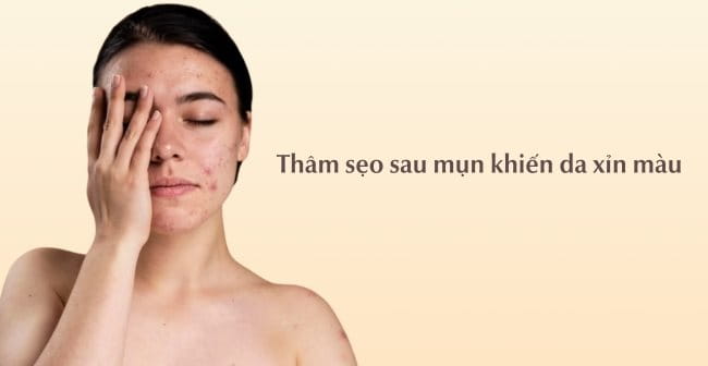 Thâm sẹo sau mụn khiến da xỉn màu