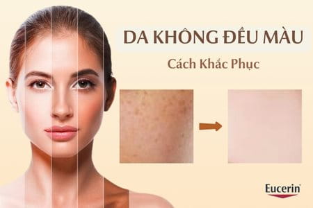 Da không đều màu