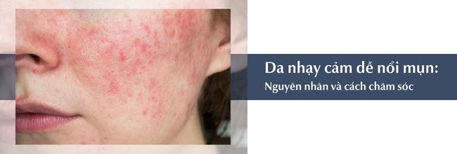 Da nhạy cảm dễ nổi mụn: Nguyên nhân và cách chăm sóc