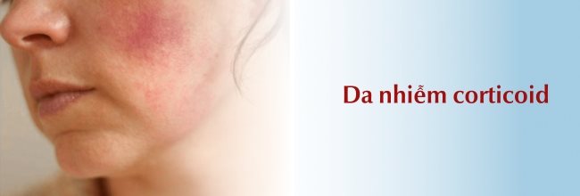 Da Nhiễm Corticoid: Dấu Hiệu Nhận Biết Và Cách Điều Trị Hiệu Quả