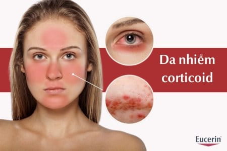 Da Nhiễm Corticoid: Dấu Hiệu  Và Cách Điều Trị Hiệu Quả