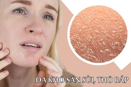 Cách điều trị da khô sần sùi, khô từng mảng