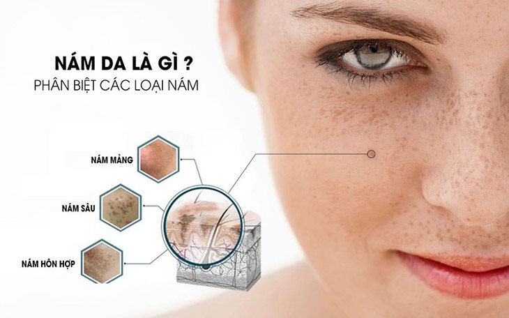 các loại nám da thường gặp