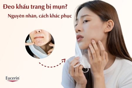 Đeo khẩu trang bị mụn do đâu? Cách khắc phục hiệu quả