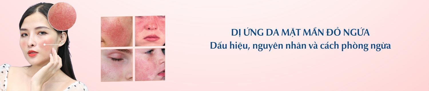 Dị ứng da mặt mẩn đỏ ngứa