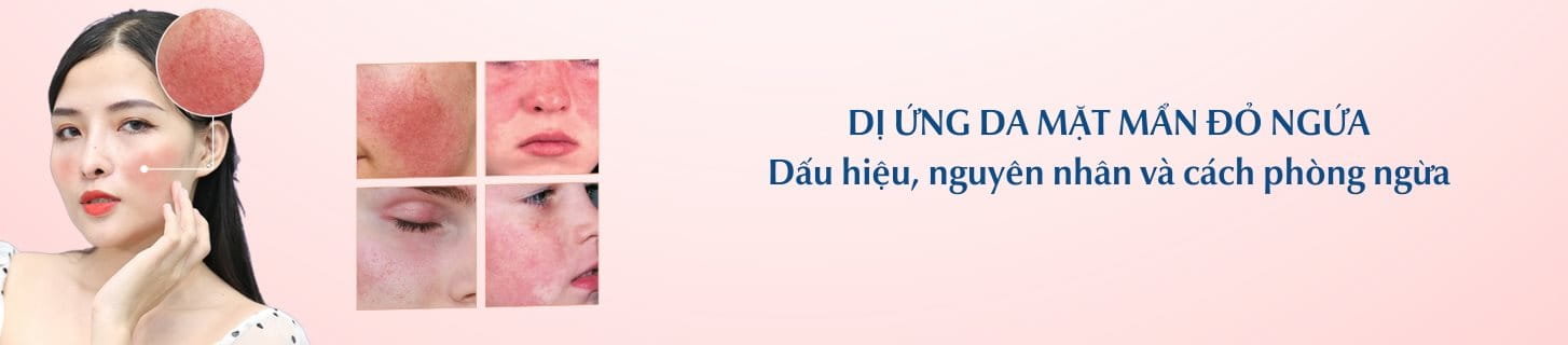 Dị ứng da mặt mẩn đỏ ngứa