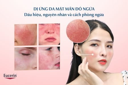 Dị ứng da mặt mẩn đỏ ngứa