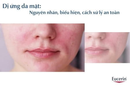 Dị ứng da mặt: Nguyên nhân, biểu hiện, cách xử lý