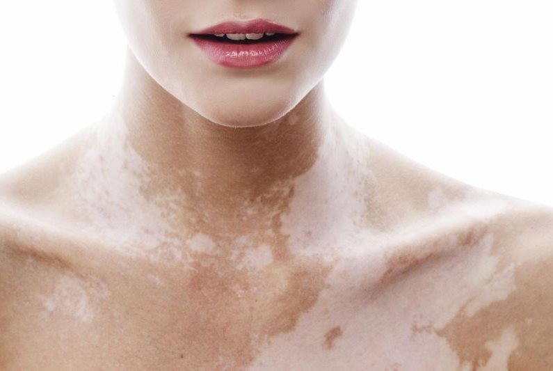 giảm sắc tố melanin