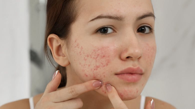 Cách chăm sóc da để ngăn ngừa mụn đỏ 2 bên má tái phát?
