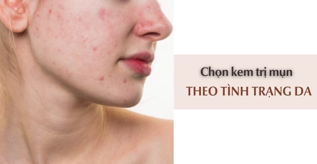 Lựa chọn kem trị mụn cho da dầu theo tình trạng da và mụn