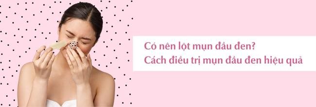 Lột mụn đầu đen ở mũi nên hay không nên? Cách trị mụn đầu đen hiệu quả