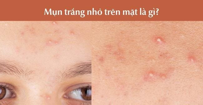 Mụn trắng nhỏ là gì?