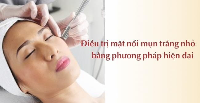 Trị mụn đầu trắng bằng công nghệ cao