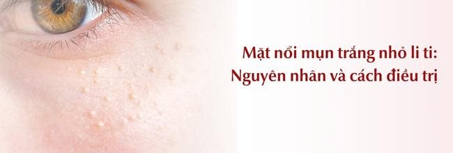 Mặt nổi mụn trắng nhỏ li ti: Nguyên nhân, cách xử lý