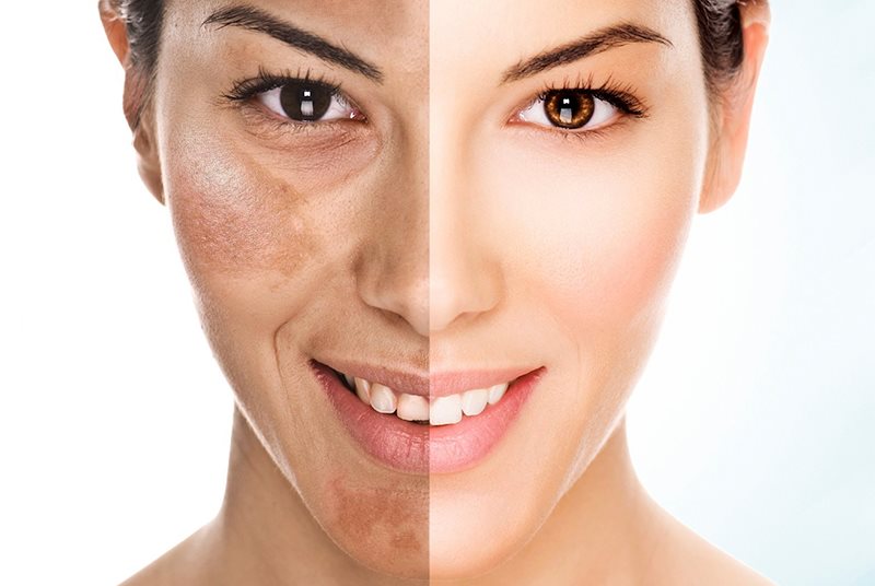 review kem trị nám hiệu quả