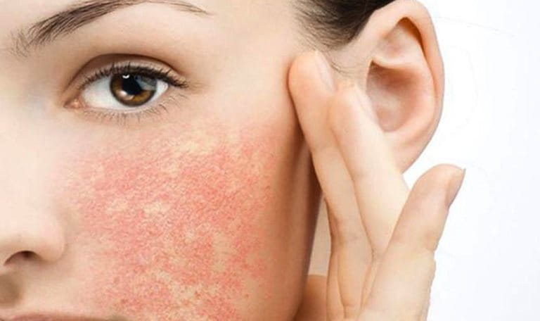 Dị ứng mỹ phẩm là tình trạng da bị nóng rát, tấy đỏ hoặc ngứa ngáy sau khi sử dụng