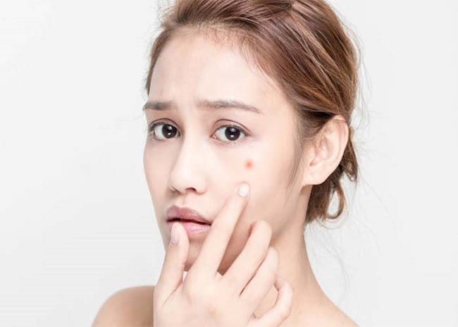 Nổi mụn là trường hợp thường gặp nhất của dị ứng mỹ phẩm