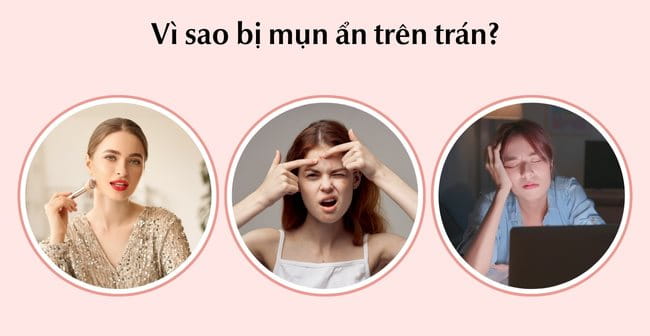 Vì sao bị mụn ẩn trên trán?