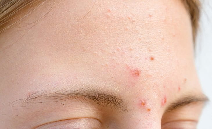 mụn ẩn trên trán