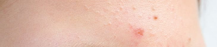 mụn ẩn trên trán