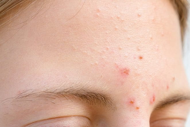 mụn ẩn trên trán