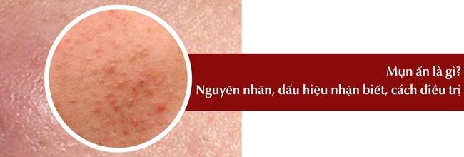 Mụn ẩn là gì? Nguyên nhân và cách điều trị mụn