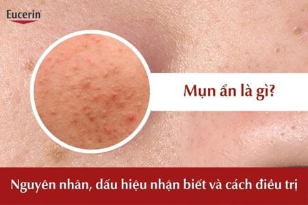 Mụn ẩn là gì? Cách trị mụn hiệu quả